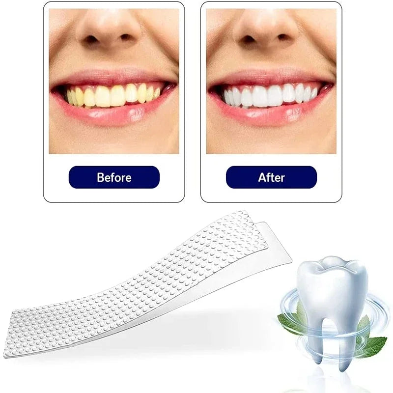 Antes y después blanqueamiento dental — resultado en 14 días